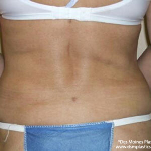 Liposuction before and after photos