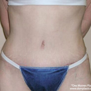 Tummy Tuck before and after photos