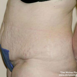Tummy Tuck before and after photos