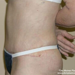 Tummy Tuck before and after photos