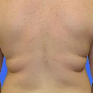 Liposuction before and after photos Liposuction before and after photos