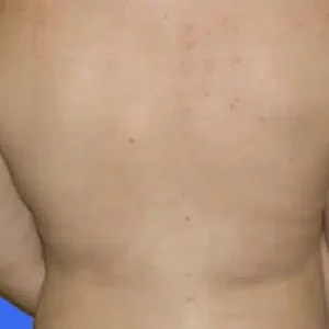 Liposuction before and after photos Liposuction before and after photos