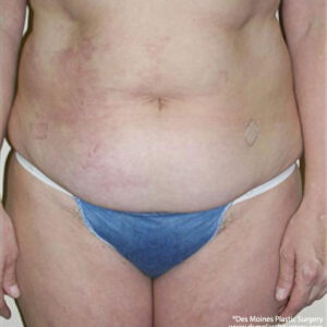 Tummy Tuck before and after photos