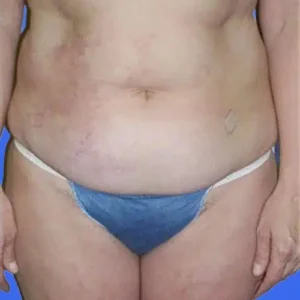 Tummy Tuck before and after photos Tummy Tuck before and after photos