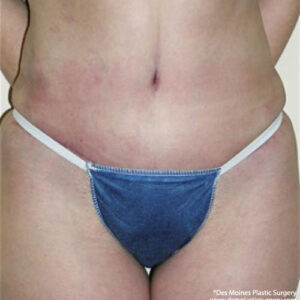 Tummy Tuck before and after photos