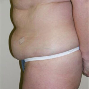 Tummy Tuck before and after photos