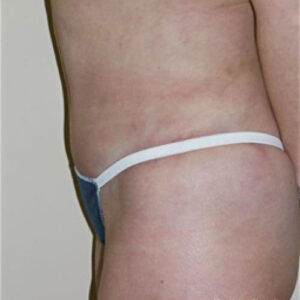 Tummy Tuck before and after photos