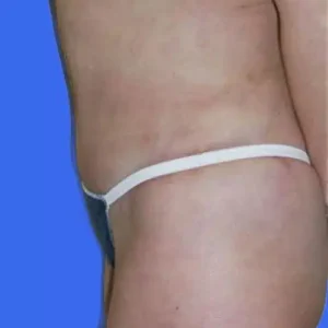Tummy Tuck before and after photos Tummy Tuck before and after photos