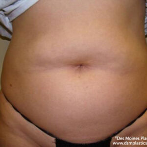 Liposuction before and after photos