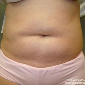 Liposuction before and after photos