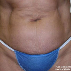 Tummy Tuck before and after photos