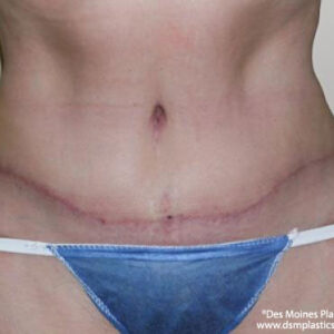 Tummy Tuck before and after photos
