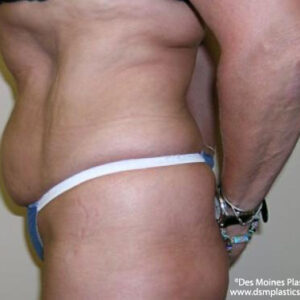 Tummy Tuck before and after photos