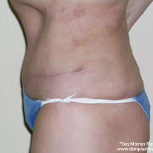 Tummy Tuck before and after photos