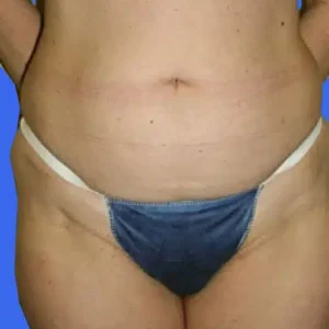 Liposuction before and after photos Liposuction before and after photos