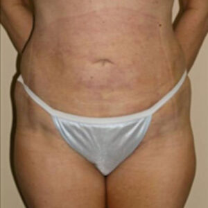 Liposuction before and after photos