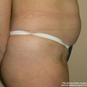 Liposuction before and after photos