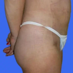 Liposuction before and after photos Liposuction before and after photos