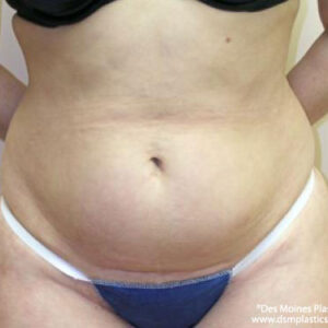 Tummy Tuck before and after photos