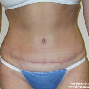 Tummy Tuck before and after photos