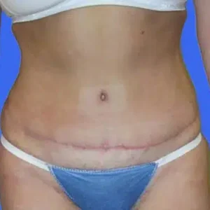 Tummy Tuck before and after photos Tummy Tuck before and after photos