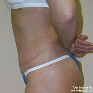 Tummy Tuck before and after photos