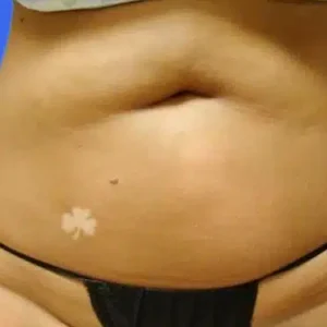 Liposuction before and after photos Liposuction before and after photos