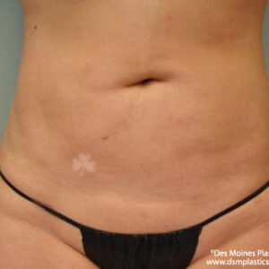 Liposuction before and after photos