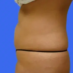 Liposuction before and after photos Liposuction before and after photos
