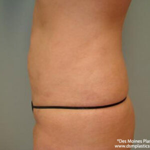 Liposuction before and after photos