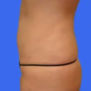 Liposuction before and after photos Liposuction before and after photos