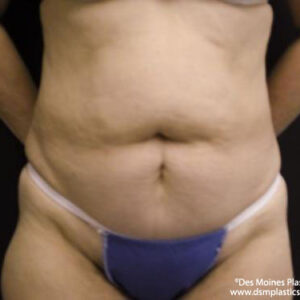 Tummy Tuck before and after photos