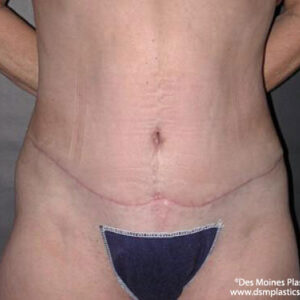 Tummy Tuck before and after photos