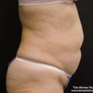 Tummy Tuck before and after photos