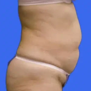 Tummy Tuck before and after photos Tummy Tuck before and after photos