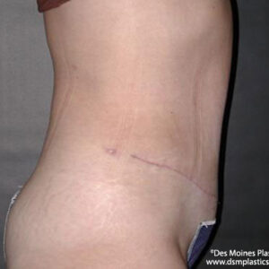 Tummy Tuck before and after photos