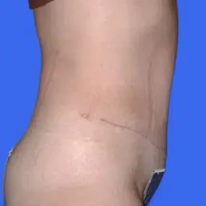 Tummy Tuck before and after photos Tummy Tuck before and after photos