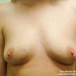 Breast Augmentation before and after photos