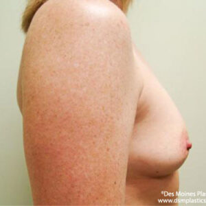 Breast Augmentation before and after photos