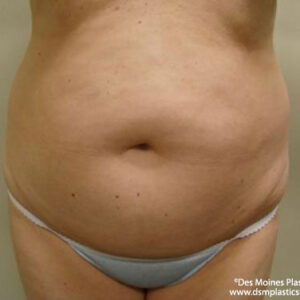 Liposuction before and after photos