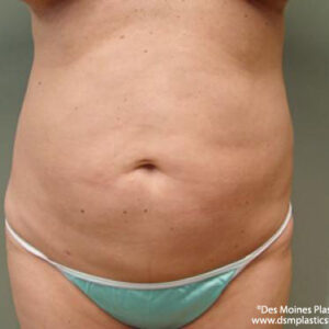 Liposuction before and after photos