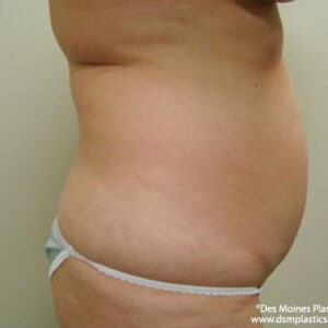 Liposuction before and after photos