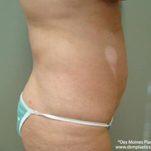 Liposuction before and after photos