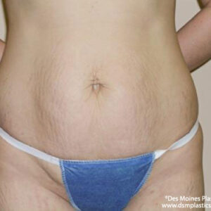 Tummy Tuck before and after photos