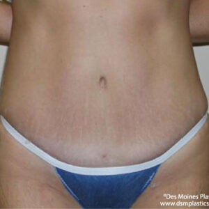 Tummy Tuck before and after photos