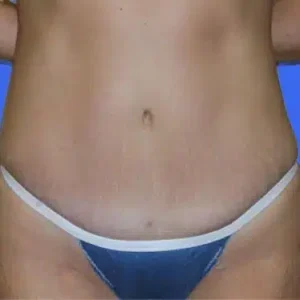 Tummy Tuck before and after photos Tummy Tuck before and after photos
