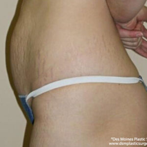 Tummy Tuck before and after photos