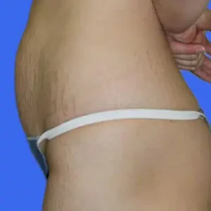 Tummy Tuck before and after photos Tummy Tuck before and after photos