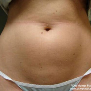 Liposuction before and after photos