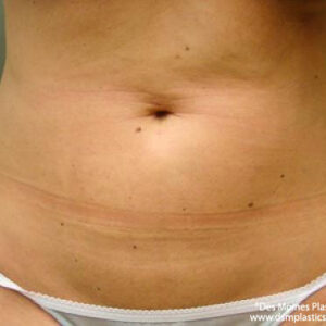 Liposuction before and after photos